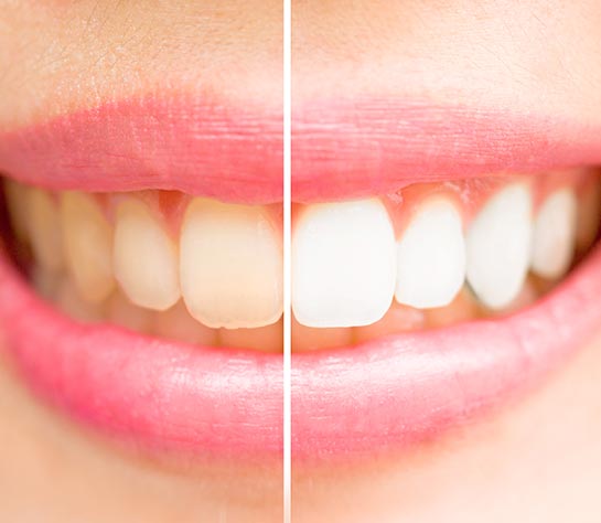 vorher-nachher-88252089